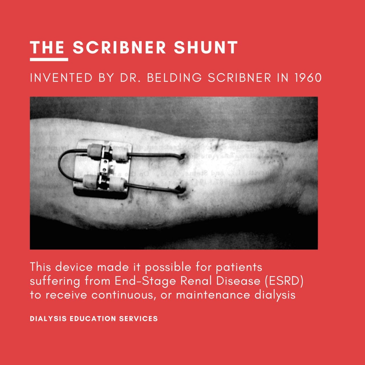Scribner shunt